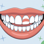 bridge dentaire collé durée de vie illustration vectorielle bouche