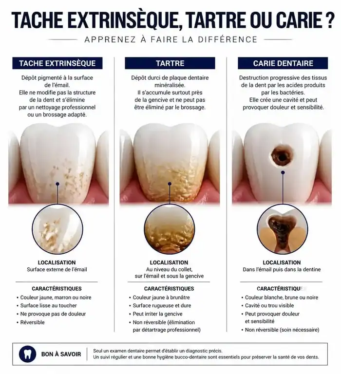 Infographie comparative pour identifier une tache noire sur les dents : carie, tartre ou coloration